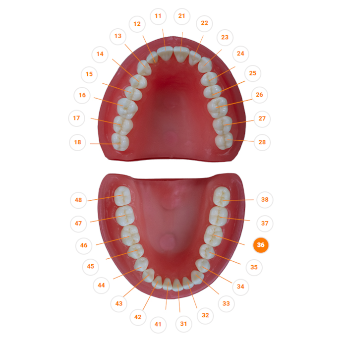 Dente Classe I na Face Oclusal DM36.1 - Pronew