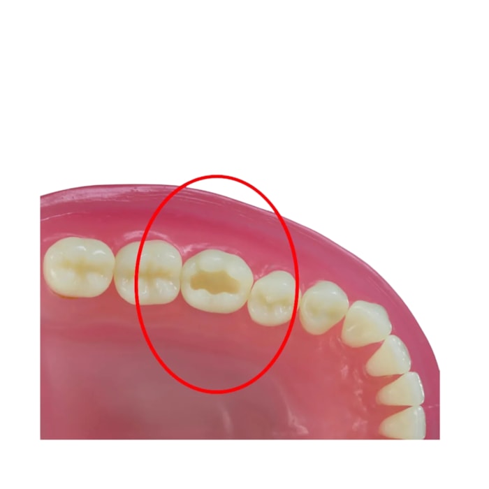 Dente Classe I na Face Oclusal DM36.1 - Pronew
