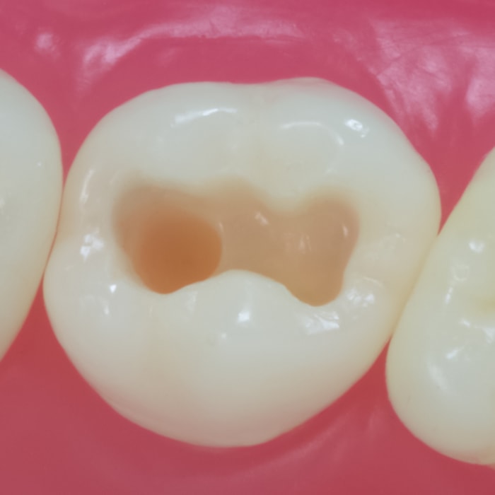 Dente Classe I na Face Oclusal Pino  DM17.5 - Pronew