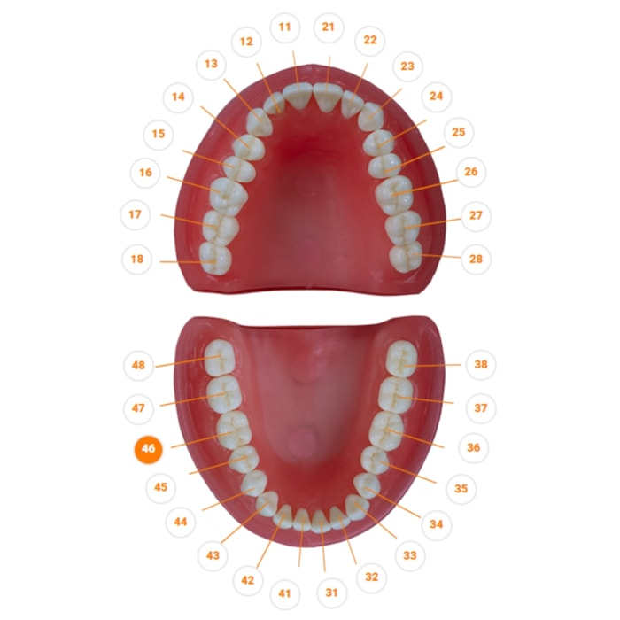 Dente Diferenciado Classe Cárie Oculta DM46.7 - Pronew