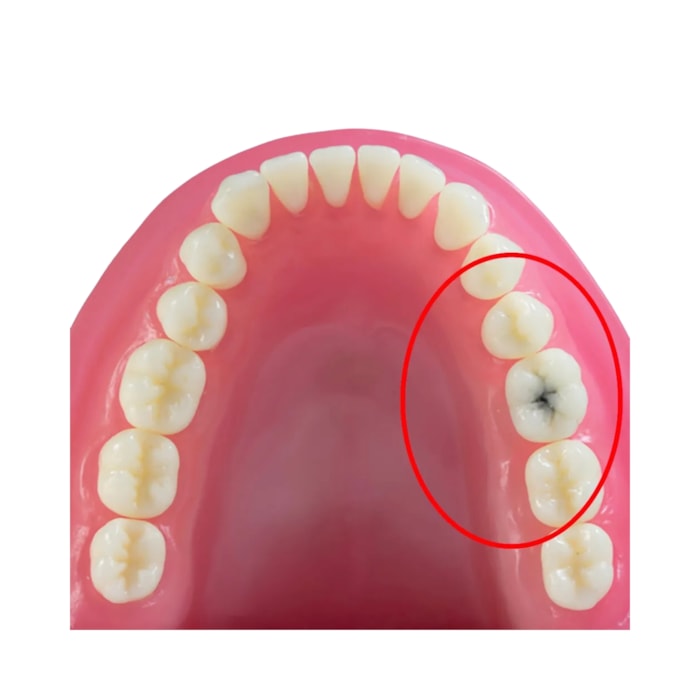 Dente Diferenciado Classe Cárie Oculta DM46.7 - Pronew