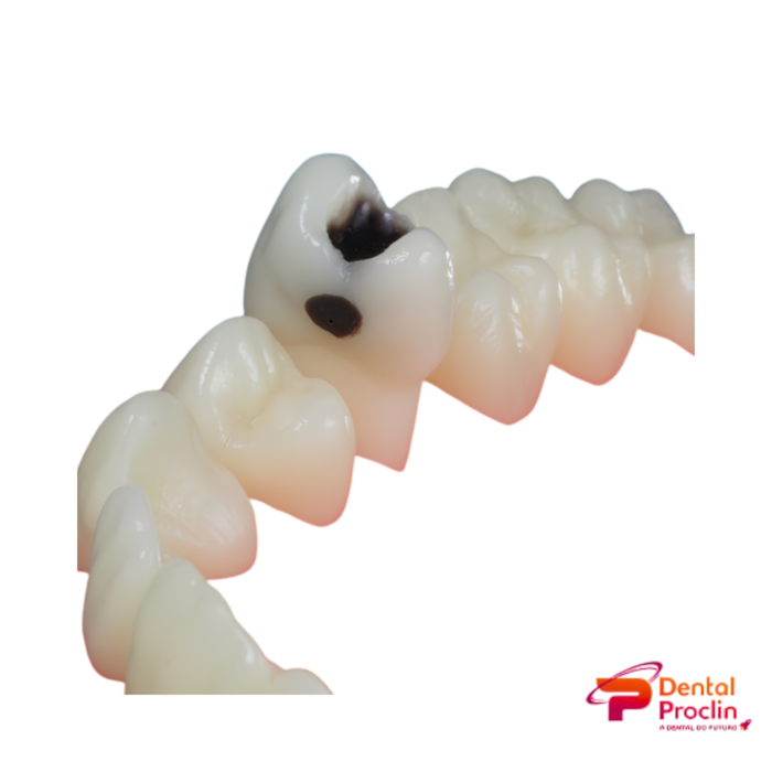 Dente Diferenciado Classe I Face MOD Cariado DM 25.2 – Pronew