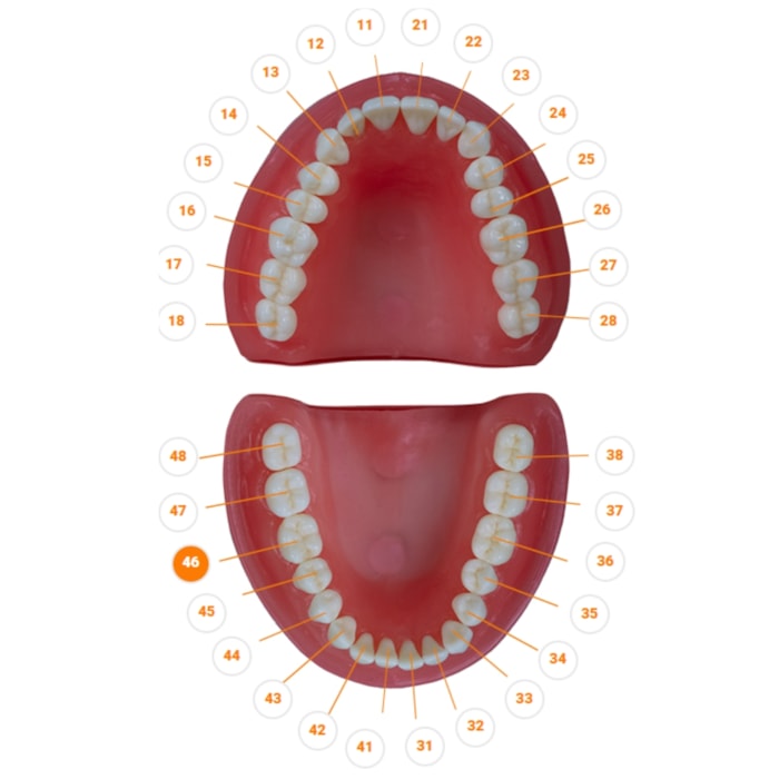 Dente Diferenciado Classe I Oclusal Cariado DM46.6 - Pronew