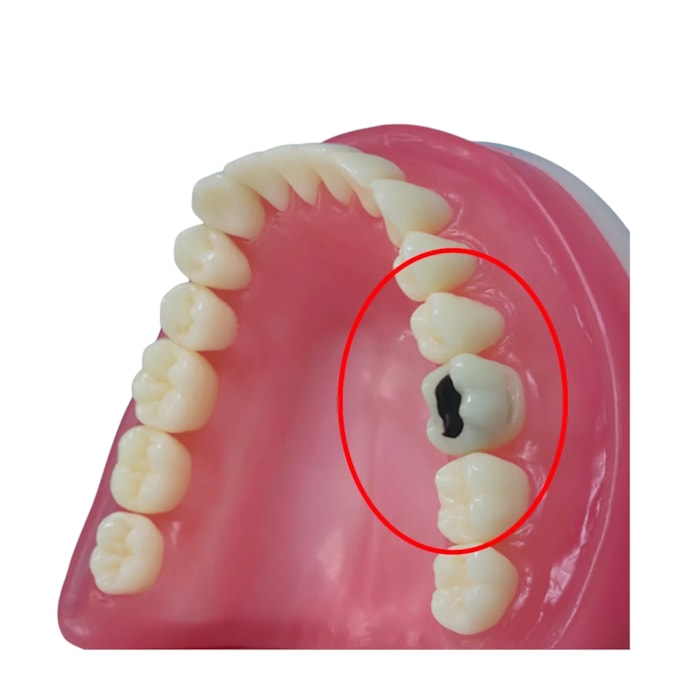 Dente Diferenciado Classe I Oclusal Cariado DM46.6 - Pronew