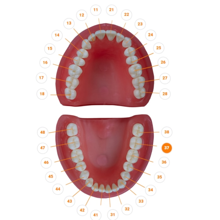 Dente Diferenciado Classe II na Face MO Cariado DM37.7 - Pronew