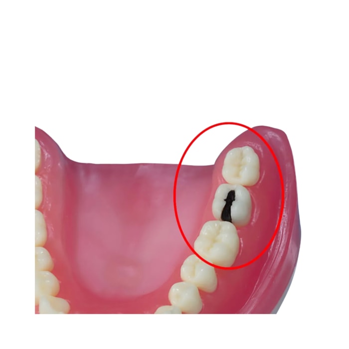 Dente Diferenciado Classe II na Face MO Cariado DM37.7 - Pronew