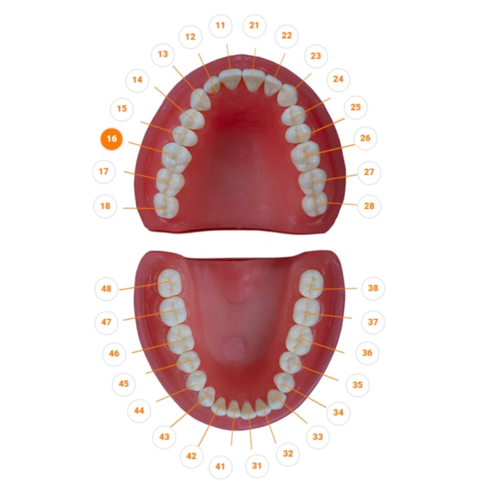 Dente Diferenciado Classe II OM Cariado com Classe V Cariado DM16.2 - Pronew