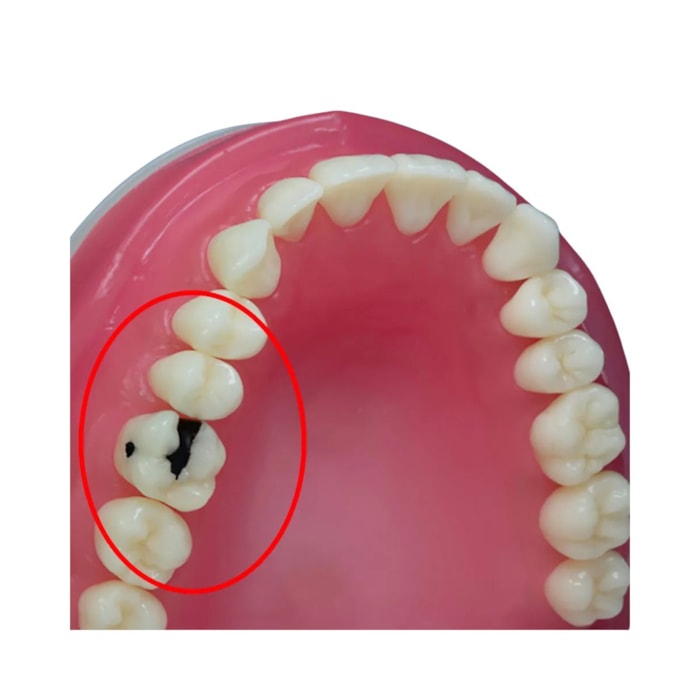 Dente Diferenciado Classe II OM Cariado com Classe V Cariado DM16.2 - Pronew