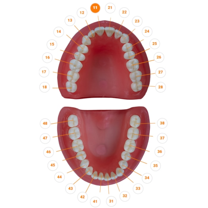 Dente Diferenciado Classe III na Face MD Cariado DM11.1 - Pronew
