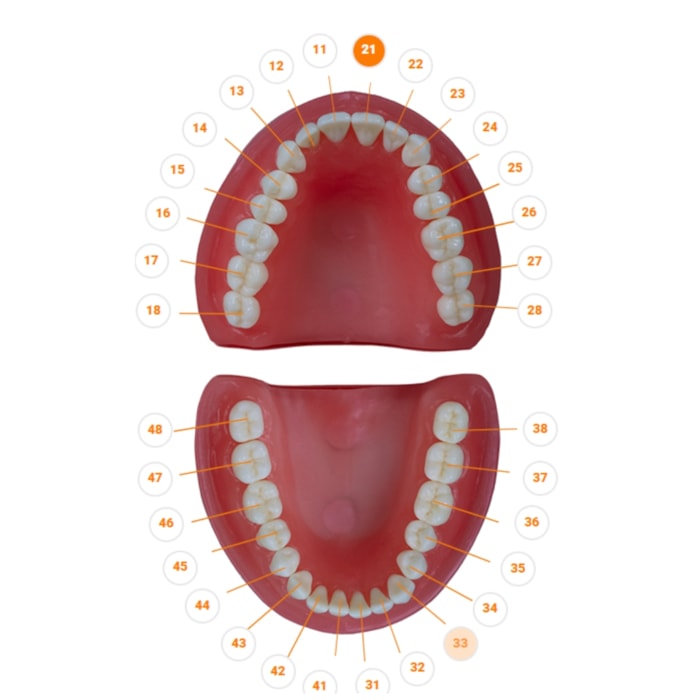Dente Diferenciado Classe IV ampla na Face Mesial DM21.13 - Pronew