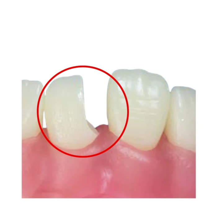 Dente Diferenciado Classe IV ampla na Face Mesial DM21.13 - Pronew