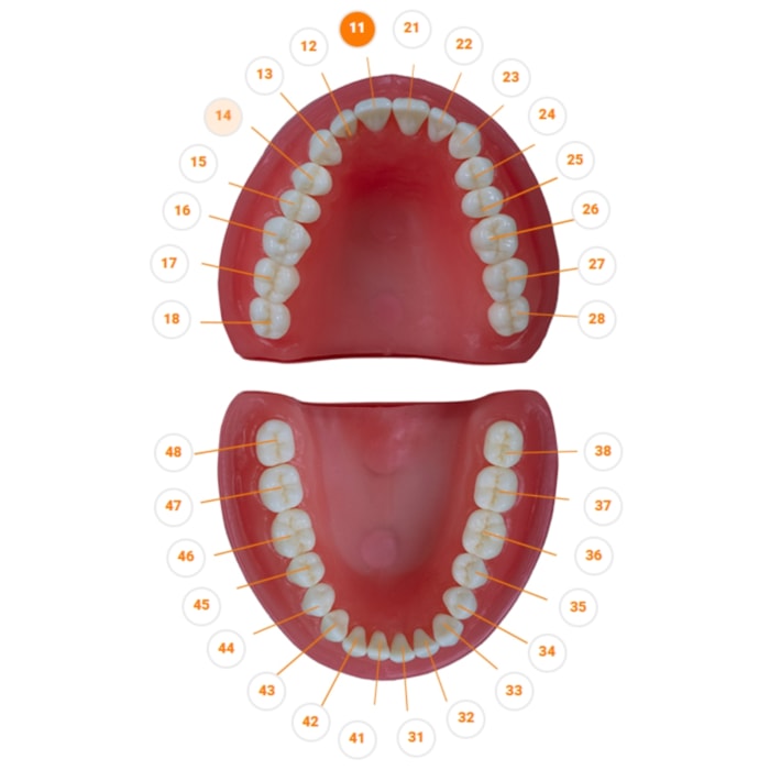 Dente Diferenciado Preparo de Faceta DM11.5 - Pronew