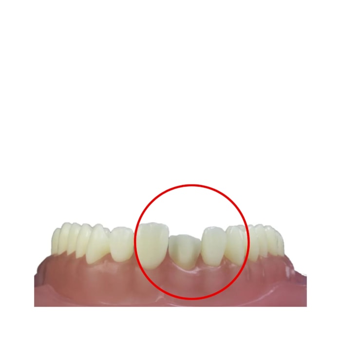 Dente Diferenciado Preparo de Faceta DM11.5 - Pronew