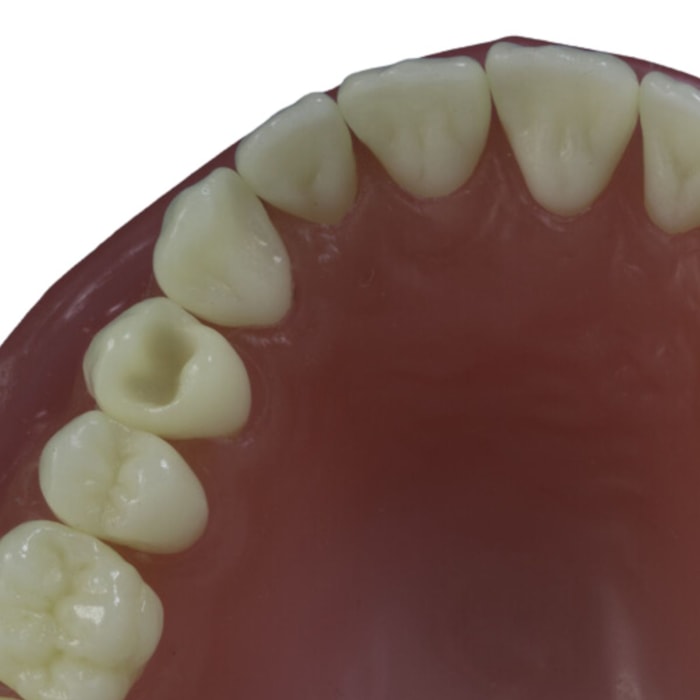 Dente para Manequim Classe 1 Face Oclusal DM 14.1 - Pronew