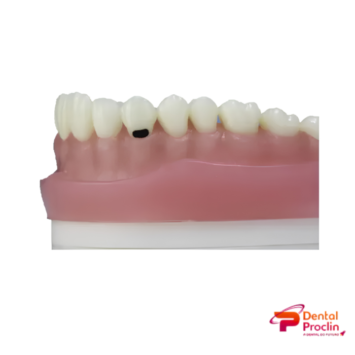Dente para Manequim Classe 5 na Face Vestibular Cariado DM 13.5 - Pronew
