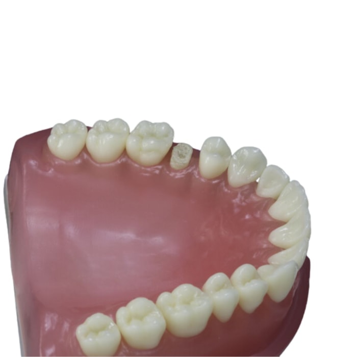 Dente para Manequim com Preparo Classe 2 Modelo DM15.3 - Pronew