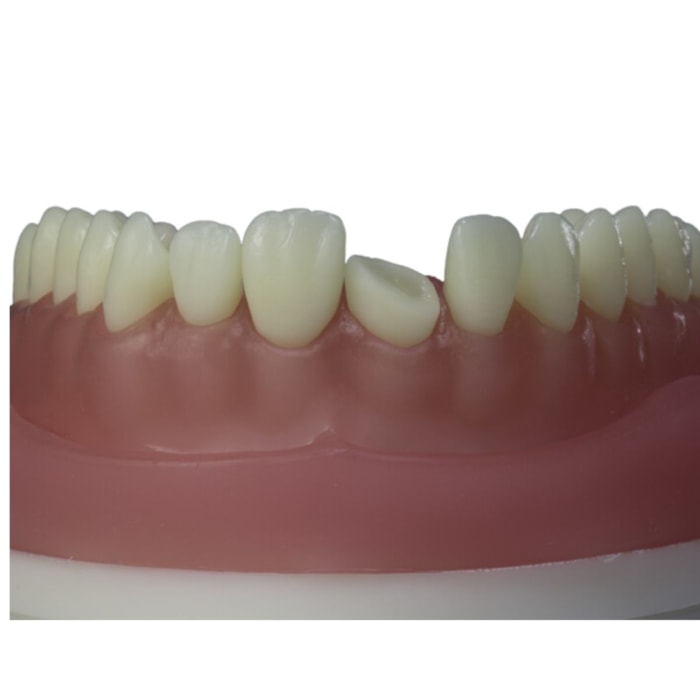 Dente para Manequim Fraturado DM 11.10 - Pronew