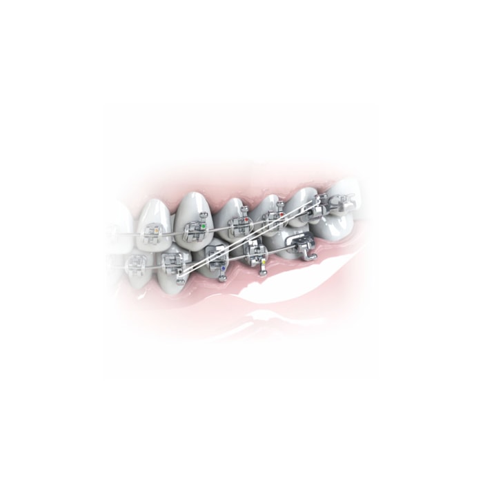Elástico Intraoral de Silicone - Morelli