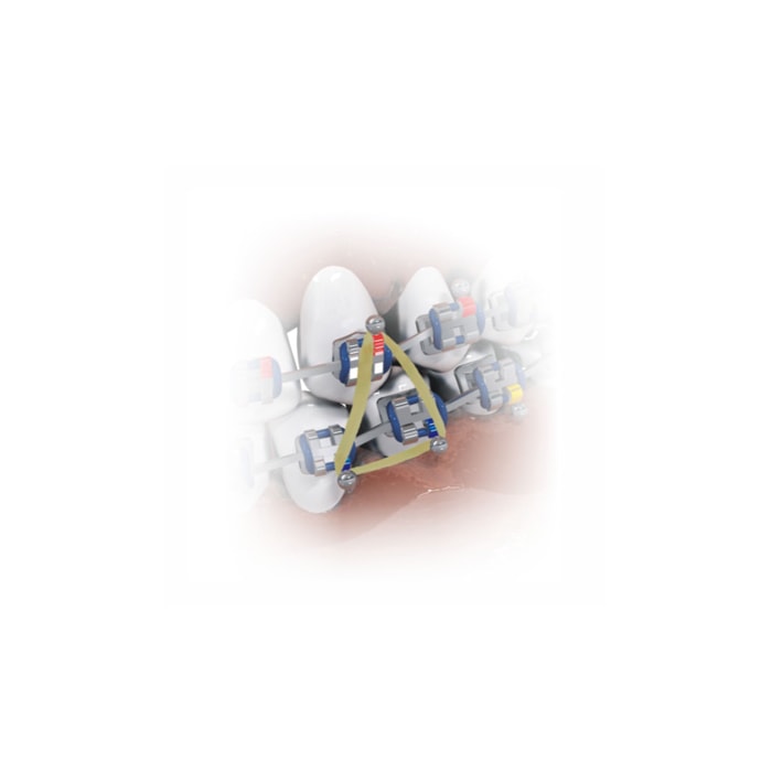 Elástico Intraoral Látex 3/8 - Morelli